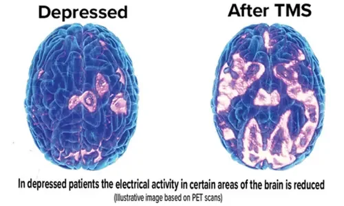 brain